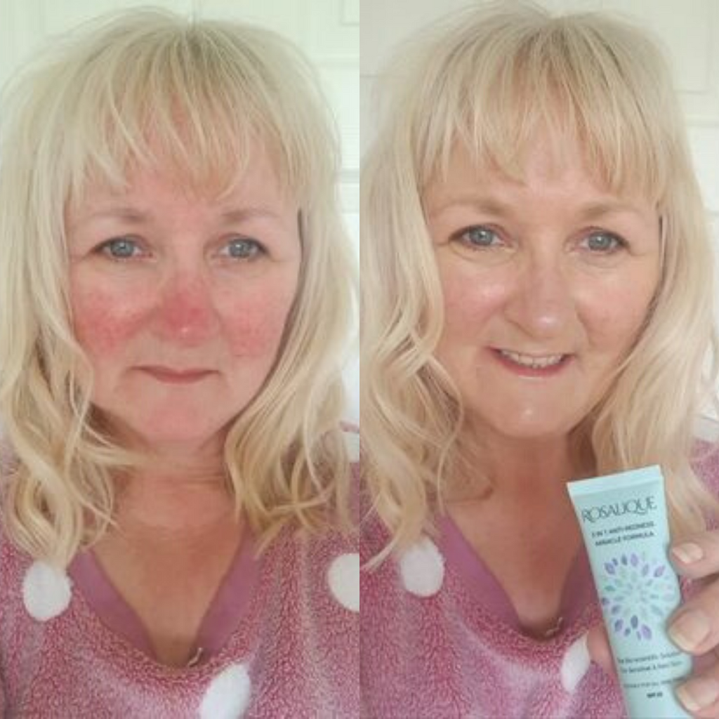 Crema Viso Anti Rossore Miracle Formula SPF50 Rosalique Rosalique crema-viso-anti-rossore-miracle-formula-spf50-rosalique-rosalique